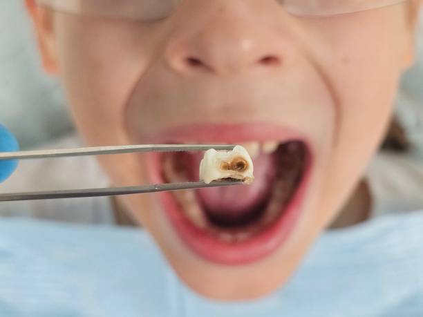 Best Emergency Tooth Extraction in Amherst, TX